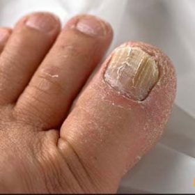 15 dấu hiệu bạn đang thiếu hụt canxi máu